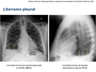 iDESIGN
by HiSlide.io
1.Derrame pleural
Cantidad mínima de líquido detectada
en AP/PA: 200 ml
Cantidad mínima de líquido
detectada en lateral: 75 ml
William Herring, Radiología Básica: Aspectos fundamentals 4a Ed Oxford Elsevier 2020
 