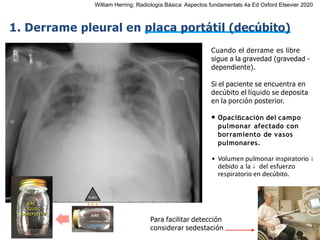 iDESIGN
by HiSlide.io
1. Derrame pleural en placa portátil (decúbito)
Cuando el derrame es libre
sigue a la gravedad (gravedad -
dependiente).
Si el paciente se encuentra en
decúbito el líquido se deposita
en la porción posterior.
• Opaciﬁcación del campo
pulmonar afectado con
borramiento de vasos
pulmonares.
• Volumen pulmonar inspiratorio ↓
debido a la ↓ del esfuerzo
respiratorio en decúbito.
AIRE
LÍQUIDO
AIRE +
LÍQUIDO
SOBREPUESTO
TUBO
Para facilitar detección
considerar sedestación
William Herring, Radiología Básica: Aspectos fundamentals 4a Ed Oxford Elsevier 2020
 