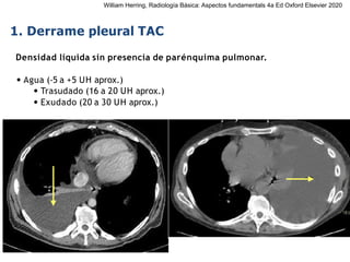 iDESIGN
by HiSlide.io
1. Derrame pleural TAC
Densidad líquida sin presencia de parénquima pulmonar.
• Agua (-5 a +5 UH aprox.)
• Trasudado (16 a 20 UH aprox.)
• Exudado (20 a 30 UH aprox.)
William Herring, Radiología Básica: Aspectos fundamentals 4a Ed Oxford Elsevier 2020
 