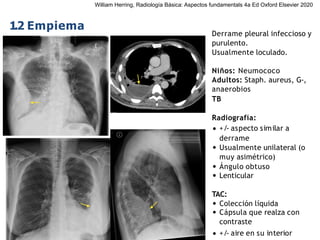 iDESIGN
by HiSlide.io
1.2 Empiema
Derrame pleural infeccioso y
purulento.
Usualmente loculado.
Niños: Neumococo
Adultos: Staph. aureus, G-,
anaerobios
TB
Radiografía:
• +/- aspecto similar a
derrame
• Usualmente unilateral (o
muy asimétrico)
• Ángulo obtuso
• Lenticular
TAC:
• Colección líquida
• Cápsula que realza con
contraste
• +/- aire en su interior
William Herring, Radiología Básica: Aspectos fundamentals 4a Ed Oxford Elsevier 2020
 