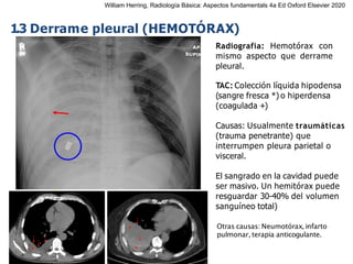 iDESIGN
by HiSlide.io
1.3 Derrame pleural (HEMOTÓRAX)
Radiografía: Hemotórax con
mismo aspecto que derrame
pleural.
TAC: Colección líquida hipodensa
(sangre fresca *) o hiperdensa
(coagulada +)
Causas: Usualmente traumáticas
(trauma penetrante) que
interrumpen pleura parietal o
visceral.
El sangrado en la cavidad puede
ser masivo. Un hemitórax puede
resguardar 30-40% del volumen
sanguíneo total)
Otras causas: Neumotórax, infarto
pulmonar, terapia anticogulante.
*
*
+
William Herring, Radiología Básica: Aspectos fundamentals 4a Ed Oxford Elsevier 2020
 