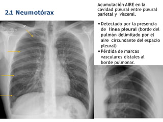 iDESIGN
by HiSlide.io
2.1 Neumotórax
Acumulación AIRE en la
cavidad pleural entre pleural
parietal y visceral.
•Detectado por la presencia
de línea pleural (borde del
pulmón delimitado por el
aire circundante del espacio
pleural)
•Pérdida de marcas
vasculares distales al
borde pulmonar.
 