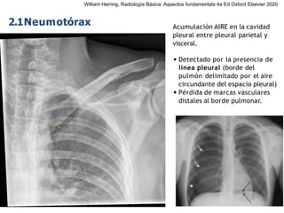 iDESIGN
by HiSlide.io
2.1Neumotórax Acumulación AIRE en la cavidad
pleural entre pleural parietal y
visceral.
• Detectado por la presencia de
línea pleural (borde del
pulmón delimitado por el aire
circundante del espacio pleural)
• Pérdida de marcas vasculares
distales al borde pulmonar.
William Herring, Radiología Básica: Aspectos fundamentals 4a Ed Oxford Elsevier 2020
 