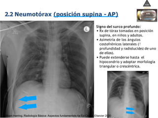 iDESIGN
by HiSlide.io
2.2 Neumotórax (posición supina - AP)
Signo del surco profundo:
• Rx de tórax tomadas en posición
supina, en niños y adultos.
• Asimetría de los ángulos
costofrénicos laterales (↑
profundidad y radiolucidez de uno
de ellos).
• Puede extenderse hasta el
hipocondrio y adoptar morfología
triangular o crescéntrica.
AIRE
LÍQUIDO
TUBO
William Herring, Radiología Básica: Aspectos fundamentals 4a Ed Oxford Elsevier 2020
 