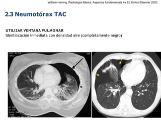 iDESIGN
by HiSlide.io
2.3 Neumotórax TAC
UTILIZAR VENTANA PULMONAR
Identiﬁcación inmediata con densidad aire (completamente negro)
William Herring, Radiología Básica: Aspectos fundamentals 4a Ed Oxford Elsevier 2020
 