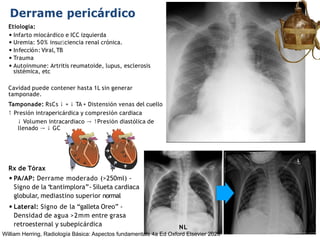 iDESIGN
by HiSlide.io
Derrame pericárdico
Rx de Tórax
•PA/AP: Derrame moderado (>250ml) -
Signo de la “
cantimplora”- Silueta cardiaca
globular, mediastino superior normal
•Lateral: Signo de la “galleta Oreo” -
Densidad de agua >2mm entre grasa
retroesternal y subepicárdica NL
Etiología:
• Infarto miocárdico e ICC izquierda
• Uremia: 50% insuﬁciencia renal crónica.
• Infección: Viral,TB
• Trauma
• Autoinmune: Artritis reumatoide, lupus, esclerosis
sistémica, etc
Cavidad puede contener hasta 1L sin generar
tamponade.
Tamponade: RsCs ↓ + ↓ TA + Distensión venas del cuello
↑ Presión intrapericárdica y compresión cardiaca
↓ Volumen intracardiaco → ↑Presión diastólica de
llenado → ↓ GC
William Herring, Radiología Básica: Aspectos fundamentals 4a Ed Oxford Elsevier 2020
 