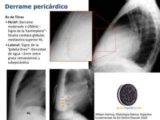 iDESIGN
by HiSlide.io
Derrame pericárdico
grasa líquido grasa
*
NL
Rx de Tórax
•PA/AP: Derrame
moderado (>250ml) -
Signo de la “
cantimplora”-
Silueta cardiaca globular,
mediastino superior NL
•Lateral: Signo de la
“
galleta Oreo”- Densidad
de agua >2mm entre
grasa retroesternal y
subepicárdica
*
William Herring, Radiología Básica: Aspectos
fundamentals 4a Ed Oxford Elsevier 2020
 