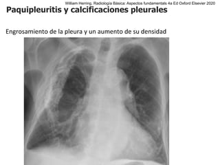 Paquipleuritis y calcificaciones pleurales
Engrosamiento de la pleura y un aumento de su densidad
William Herring, Radiología Básica: Aspectos fundamentals 4a Ed Oxford Elsevier 2020
 