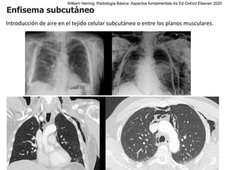 Enfisema subcutáneo
Introducción de aire en el tejido celular subcutáneo o entre los planos musculares.
William Herring, Radiología Básica: Aspectos fundamentals 4a Ed Oxford Elsevier 2020
 