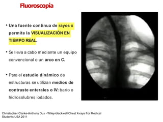 iDESIGN
by HiSlide.io
Fluoroscopía
• Una fuente continua de rayos x
permite la VISUALIZACIÓN EN
TIEMPO REAL.
• Se lleva a cabo mediante un equipo
convencional o un arco en C.
• Para el estudio dinámico de
estructuras se utilizan medios de
contraste enterales o IV: bario o
hidrosolubres iodados.
Christopher Clarke-Anthony Dux - Wiley-blackwell Chest X-rays For Medical
Students USA 2011
 