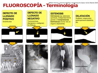 iDESIGN
by HiSlide.io
FLUOROSCOPÍA - Terminología
DEFECTO DE
LLENADO
POSITIVO
Divertículos
Enfermedad
diverticular del colon
Acalasia esofágica
Carcinoma de colon
Carcinoma esofágico
DEFECTO DE
LLENADO
NEGATIVO
Tumoraciones
(benignas o malignas).
EJ
. Pólipos.
DILATACIÓN
Acalasia, megaureter,
gastroparesia diabética,
etc.
ESTENOSIS
Intrínsecas (ej. estenosis
químicas, malignidad de la
pared) o Compresiones
Extrínsecas (tumor de un
órgano adyacente)
William Herring. Learning radiology: recognizing the basics. 4a Ed. Elsevier 2020
 