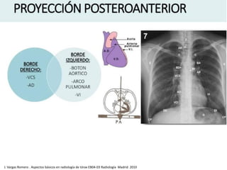 J. Vargas Romero . Aspectos básicos en radiología de tórax EB04-03 Radiología Madrid 2010
 