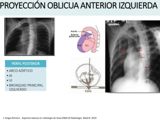 J. Vargas Romero . Aspectos básicos en radiología de tórax EB04-03 Radiología Madrid 2010
 