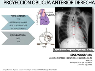 J. Vargas Romero . Aspectos básicos en radiología de tórax EB04-03 Radiología Madrid 2010
ESOFAGOGRAMA
Estrechamientos de columna esofágica baritada
Aórtico
Bronquial principal izquierdo
Auricular izquierdo
 
