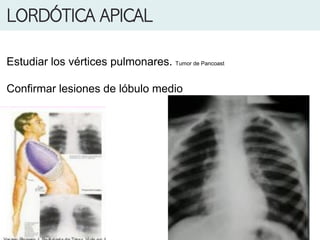 LORDÓTICA APICAL
Estudiar los vértices pulmonares. Tumor de Pancoast
Confirmar lesiones de lóbulo medio
 