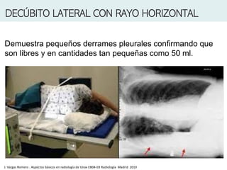 DECÚBITO LATERAL CON RAYO HORIZONTAL
Demuestra pequeños derrames pleurales confirmando que
son libres y en cantidades tan pequeñas como 50 ml.
J. Vargas Romero . Aspectos básicos en radiología de tórax EB04-03 Radiología Madrid 2010
 