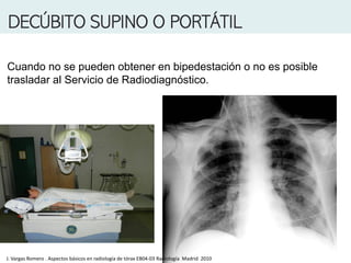 DECÚBITO SUPINO O PORTÁTIL
Cuando no se pueden obtener en bipedestación o no es posible
trasladar al Servicio de Radiodiagnóstico.
J. Vargas Romero . Aspectos básicos en radiología de tórax EB04-03 Radiología Madrid 2010
 