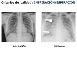 Criterios de ‘calidad’: INSPIRACIÓN/ESPIRACIÓN
INSPIRACIÓN ESPIRACIÓN
Elevación
diafragmática
Agrupación
vascular, falsa
congestión
 