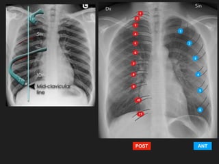 1
2
3
4
5
6
1
2
3
4
5
6
7
8
9
10
11
ANT
POST
 