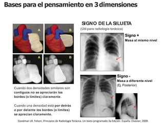 iDESIGN
by HiSlide.io
Cuando dos densidades similares son
contiguos no se apreciarán los
bordes (o límites) claramente.
Cuando una densidad está por detrás
o por delante los bordes (o límites)
se aprecian claramente.
A
A B
B
SIGNO DELA SILUETA
(Útil para radiología torácica)
Signo +
Masa al mismo nivel
Signo -
Masa a diferente nivel
(Ej. Posterior)
Bases para el pensamiento en 3dimensiones
Goodman LR. Felson. Principios de Radiología Torácica. Un texto programado.3a Edición. España: Elsevier; 2009.
 