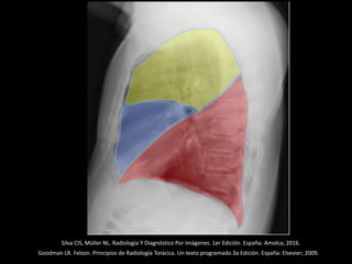 Goodman LR. Felson. Principios de Radiología Torácica. Un texto programado.3a Edición. España: Elsevier; 2009.
Silva CIS, Müller NL. Radiología Y Diagnóstico Por Imágenes. 1er Edición. España: Amolca; 2016.
 