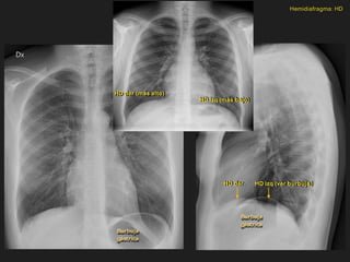 Burbuja
gástrica
Burbuja
gástrica
HD der (más alto)
HD izq (más bajo)
HD izq (ver burbuja)
HD der
Hemidiafragma: HD
 