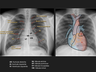 AD: Aurícula derecha
AI: Aurícula izquierda
VI: Ventrículo izquierdo
VA: Válvula aórtica
VP: Válvula pulmonar
VT: Válvula tricuspídea
VM: Válvula mitral
AD
VD
AI
VI
Tr
Mt
Ao
P
Botón aórtico
Arteria pulmonar
AI
VI
Art. subclavia
Vena
cava superior
Vena
cava inferior
Arteria pulmonar
derecha ‘interlobar’
AD
VA
VP
VT
VM
Aorta**
 