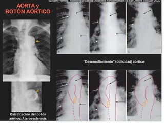 AORTA y
BOTÓN AÓRTICO
“Desenrollamiento” (dolicidad) aórtico
Calciﬁcación del botón
aórtico: Ateroesclerosis
William Herring, Radiología Básica: Aspectos fundamentals 4a Ed Oxford Elsevier 2020
 