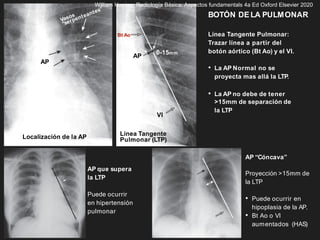 BOTÓN DE LA PULMONAR
Localización de la AP
AP
Línea Tangente
Pulmonar (LTP)
Bt Ao
VI
0-15mm
AP
AP que supera
la LTP
Puede ocurrir
en hipertensión
pulmonar
AP “Cóncava”
Proyección >15mm de
la LTP
• Puede ocurrir en
hipoplasia de la AP.
• Bt Ao o VI
aumentados (HAS)
Línea Tangente Pulmonar:
Trazar línea a partir del
botón aórtico (Bt Ao) y el VI.
• La AP Normal no se
proyecta mas allá la LTP.
• La AP no debe de tener
>15mm de separación de
la LTP
William Herring, Radiología Básica: Aspectos fundamentals 4a Ed Oxford Elsevier 2020
 