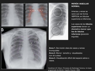 PATRÓN VASCULAR
NORMAL
Arterias y venas se
ramiﬁcan de forma
VERTICAL en lóbulos
superiores e inferiores.
Los vasos de los lóbulos
superiores tienen un
díametro menor que
los de lóbulos
inferiores (posición
erguida)
Zona 1. Deﬁnición clara de vasos y ramas
bronquiales
Zona 2. Menor tamaño y visualizados
con diﬁcultad.
Zona 3. Visualización difícil del espacio aéreo o
vasos.
Goodman LR. Felson. Principios de Radiología Torácica. Un texto
programado.3a Edición. España: Elsevier; 2009.
 