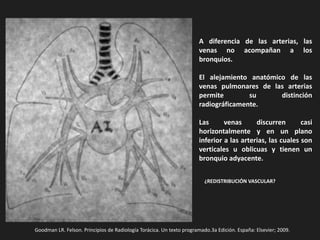 A diferencia de las arterias, las
venas no acompañan a los
bronquios.
El alejamiento anatómico de las
venas pulmonares de las arterias
permite su distinción
radiográficamente.
Las venas discurren casi
horizontalmente y en un plano
inferior a las arterias, las cuales son
verticales u oblicuas y tienen un
bronquio adyacente.
¿REDISTRIBUCIÓN VASCULAR?
Goodman LR. Felson. Principios de Radiología Torácica. Un texto programado.3a Edición. España: Elsevier; 2009.
 