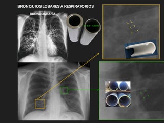 0.6 - 1.5mm
BRONQUIOSLOBARES A RESPIRATORIOS
BRONCOGRAFÍA
 