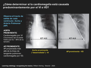 Observe el tracto de
salida de cada
ventrículo: Aorta y
Arteria Pulmonar
(AP)
AORTA
PROMINENTE:
Cardiomegalia por VI
Crecimiento del VI visible
hasta que ha ↑ 66% de su
tamaño.
AP PROMINENTE:
AP proyectada más
allá de la línea de
tangente pulmonar,
cardiomegalia por VD.
¿Cómo determinar si la cardiomegalia está causada
predominantemente por el VI o VD?
Learning radiology: recognizing the basics. William Herring - Elsevier - 2020
Aorta prominente
(“desenrollada”) - VI
AP prominente - VD
ICT >0.5 ICT >0.5
 