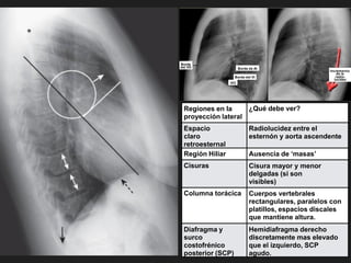 Borde
del VD Borde de AI
VCI
Incremento
de la
radio-
lucidez
Borde del VI
Regiones en la
proyección lateral
¿Qué debe ver?
Espacio
claro
retroesternal
Radiolucidez entre el
esternón y aorta ascendente
Región Hiliar Ausencia de ‘masas’
Cisuras Cisura mayor y menor
delgadas (si son
visibles)
Columna torácica Cuerpos vertebrales
rectangulares, paralelos con
platillos, espacios discales
que mantiene altura.
Diafragma y
surco
costofrénico
posterior (SCP)
Hemidiafragma derecho
discretamente mas elevado
que el izquierdo, SCP
agudo.
 