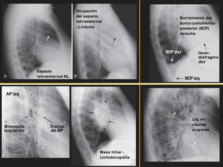 Espacio
retroesternal NL
Ocupación
del espacio
retroesternal
- Linfoma
AP izq
Bronquio
izquierdo
Tronco
de AP
Masa hiliar -
Linfadenopatía
Líq. en
cisuras
mayores
Borramiento del
surco costofrénico
posterior (SCP)
derecho
SCP der
SCP izq
Hemi-
diafragma
der
 