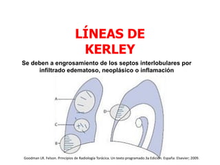 LÍNEAS DE
KERLEY
Se deben a engrosamiento de los septos interlobulares por
infiltrado edematoso, neoplásico o inflamación
Goodman LR. Felson. Principios de Radiología Torácica. Un texto programado.3a Edición. España: Elsevier; 2009.
 
