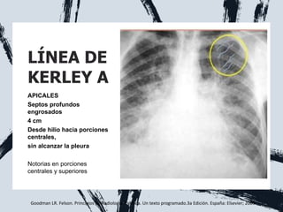 LÍNEA DE
KERLEY A
APICALES
Septos profundos
engrosados
4 cm
Desde hilio hacia porciones
centrales,
sin alcanzar la pleura
Notorias en porciones
centrales y superiores
Goodman LR. Felson. Principios de Radiología Torácica. Un texto programado.3a Edición. España: Elsevier; 2009.
 