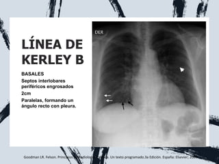 LÍNEA DE
KERLEY B
BASALES
Septos interlobares
periféricos engrosados
2cm
Paralelas, formando un
ángulo recto con pleura.
Goodman LR. Felson. Principios de Radiología Torácica. Un texto programado.3a Edición. España: Elsevier; 2009.
 