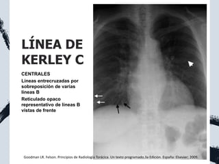 LÍNEA DE
KERLEY C
CENTRALES
Líneas entrecruzadas por
sobreposición de varias
líneas B
Reticulado opaco
representativo de líneas B
vistas de frente
Goodman LR. Felson. Principios de Radiología Torácica. Un texto programado.3a Edición. España: Elsevier; 2009.
 