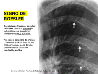 SIGNO DE
ROESLER
Escotaduras (muesca) costales
inferiores debido a erosión por
tortuosidades de las arterias
Intercostales (muy pulsátiles)
Asociado a desarrollo de arterias
colaterales entre un área de alta
presión vascular y otra de baja
presión arterias distal a la
coartación aórtica
Goodman LR. Felson. Principios de Radiología Torácica. Un texto programado.3a Edición. España: Elsevier; 2009.
 