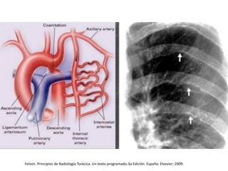 Felson. Principios de Radiología Torácica. Un texto programado.3a Edición. España: Elsevier; 2009.
 