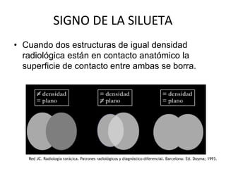 SIGNO DE LA SILUETA
• Cuando dos estructuras de igual densidad
radiológica están en contacto anatómico la
superficie de contacto entre ambas se borra.
Red JC. Radiología torácica. Patrones radiológicos y diagnóstico diferencial. Barcelona: Ed. Doyma; 1993.
 