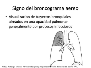 Signo del broncograma aereo
• Visualizacion de trayectos bronquiales
aireados en una opacidad pulmonar
generalmente por procesos infecciosos
Red JC. Radiología torácica. Patrones radiológicos y diagnóstico diferencial. Barcelona: Ed. Doyma; 1993.
 