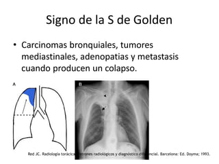Signo de la S de Golden
• Carcinomas bronquiales, tumores
mediastinales, adenopatias y metastasis
cuando producen un colapso.
Red JC. Radiología torácica. Patrones radiológicos y diagnóstico diferencial. Barcelona: Ed. Doyma; 1993.
 
