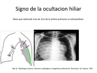 Signo de la ocultacion hiliar
Masa que sobresale mas de 1cm de la arteria pulmonar es extracardiaca
Red JC. Radiología torácica. Patrones radiológicos y diagnóstico diferencial. Barcelona: Ed. Doyma; 1993.
 