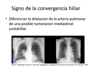 Signo de la convergencia hiliar
• Diferenciar la dilatacion de la arteria pulmonar
de una posible tumoracion mediastinal
yuxtahiliar
Red JC. Radiología torácica. Patrones radiológicos y diagnóstico diferencial. Barcelona: Ed. Doyma; 1993.
 