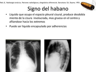 Signo del habano
• Liquido que ocupa el espacio pleural cisural, produce desdobla
miento de la cisura involucrada, mas gruesa en el centro y
afilandose hacia los extremos
• Puede ser liquido encapsulado por adherencias
Red JC. Radiología torácica. Patrones radiológicos y diagnóstico diferencial. Barcelona: Ed. Doyma; 1993.
 