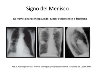 Signo del Menisco
Derrame pleural encapsulado, tumor evanescente o fantasma
Red JC. Radiología torácica. Patrones radiológicos y diagnóstico diferencial. Barcelona: Ed. Doyma; 1993.
 