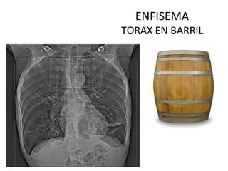 ENFISEMA
TORAX EN BARRIL
 
