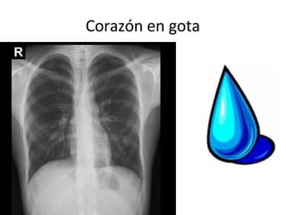 Corazón en gota
 